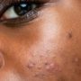 How to Get Rid Of Acne Scars