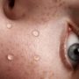 Skin Hydration
