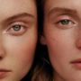 hyperpigmentation