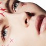 anti-wrinkle injections