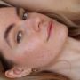 Foods That Cause Acne