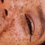 hydroquinone