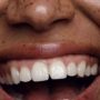 whiter teeth