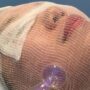 Non-surgical aesthetic treatments