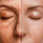 skin analysis