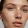 hormonal acne